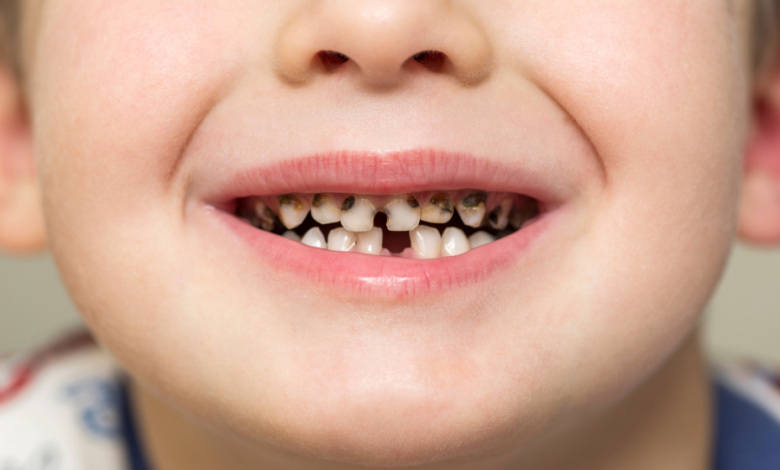 Çocuklarda Diş Çürümesi | Okulda Doğru Beslenme